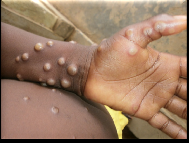 textbuffet-Mpox Outbreak: What You Need to Know to Stay Safe!